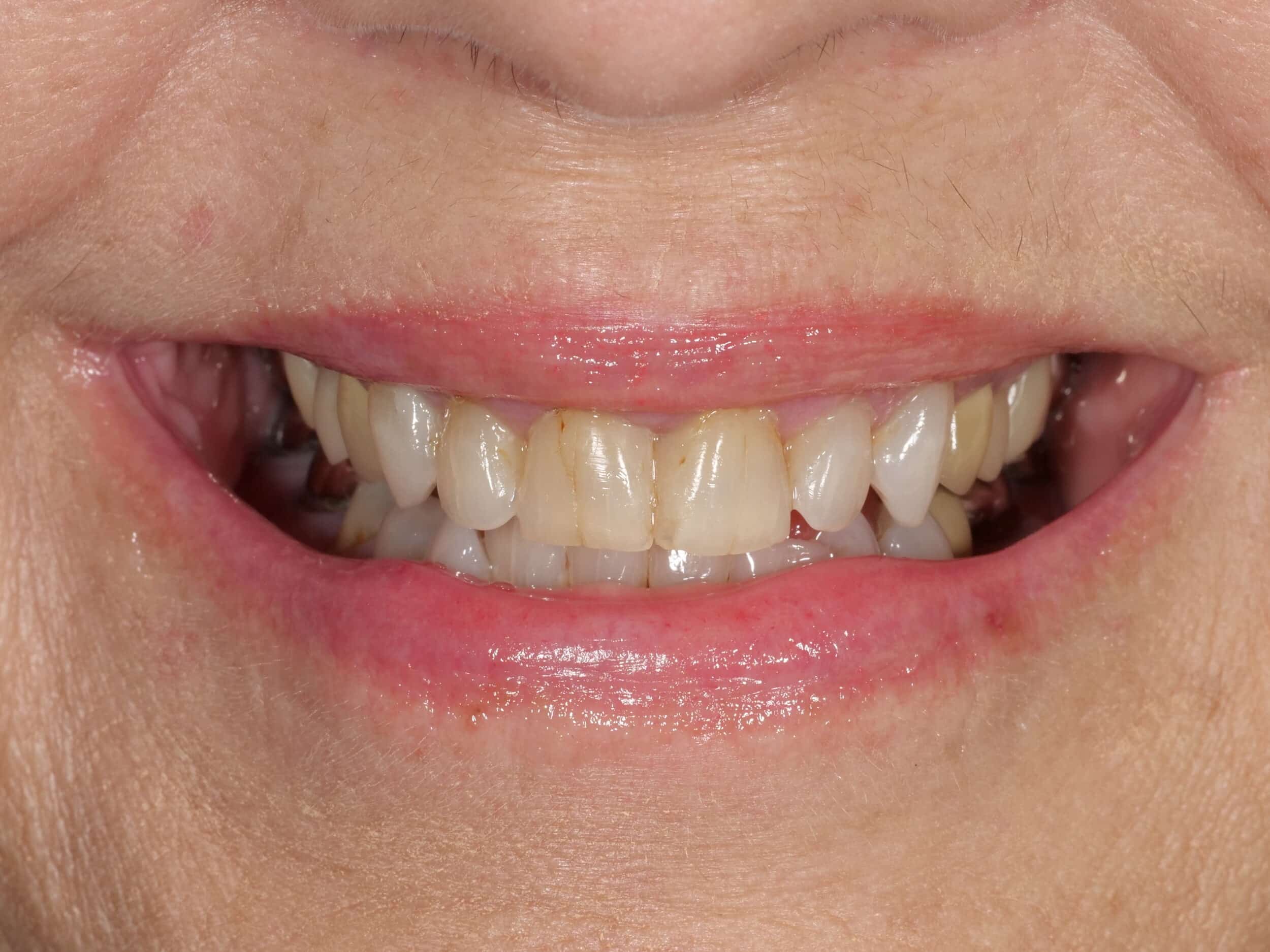 Before Image: Smile Makeover - front