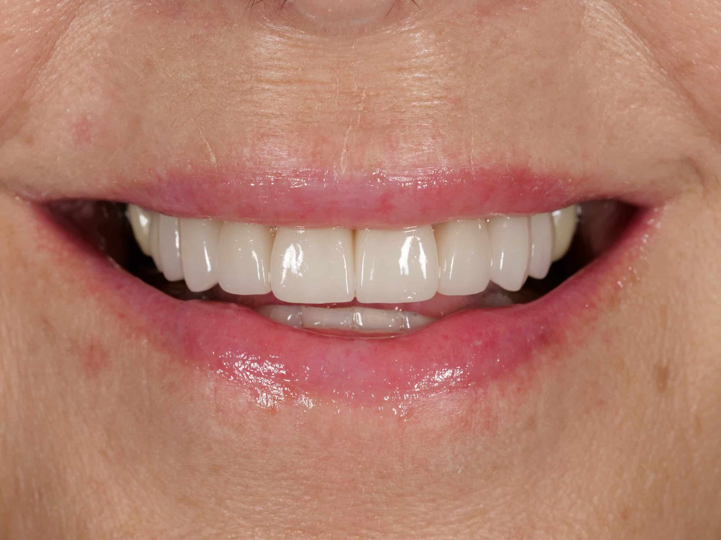 After Image: Smile Makeover - front