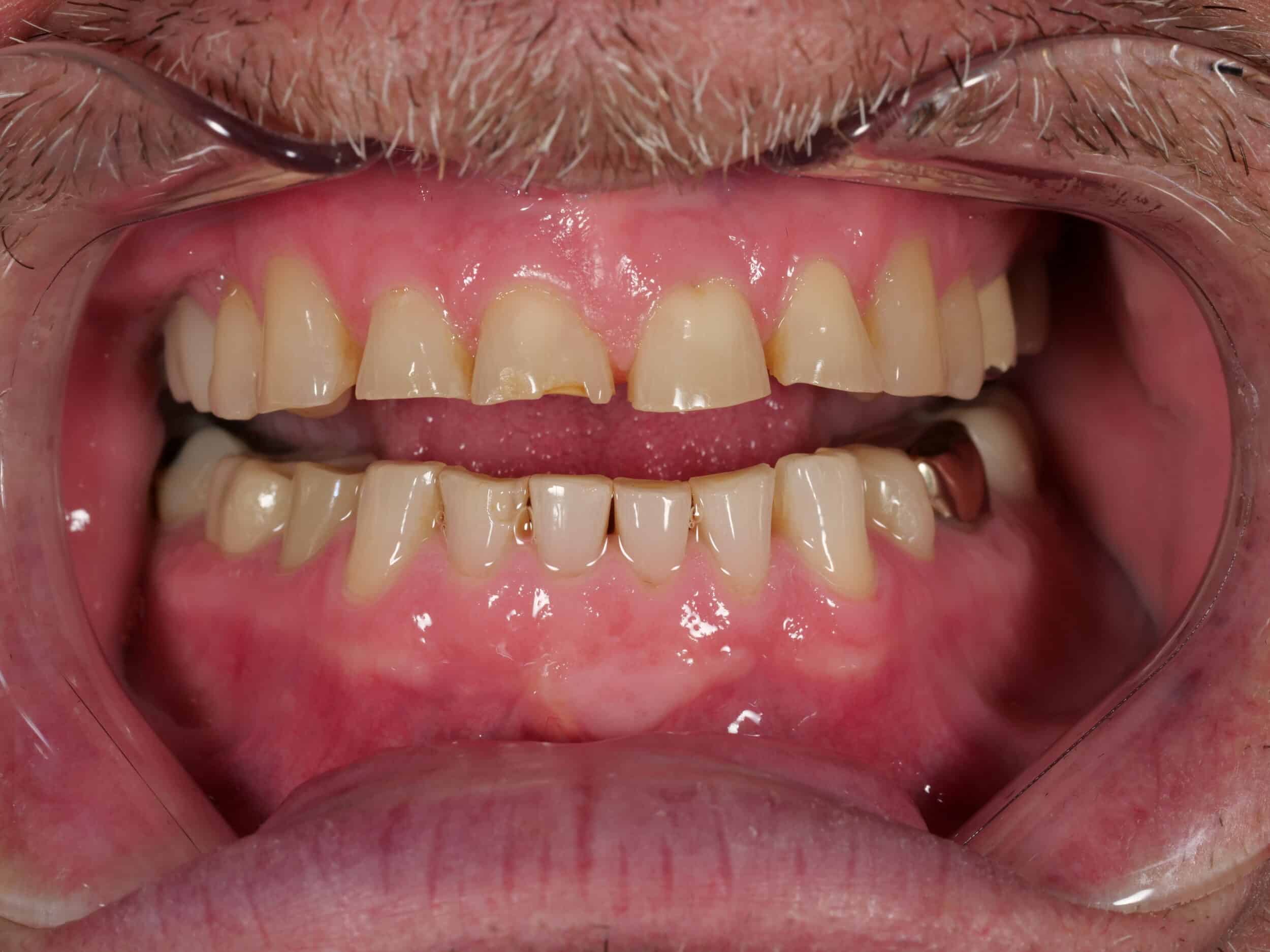 Before Image: Crowns - front