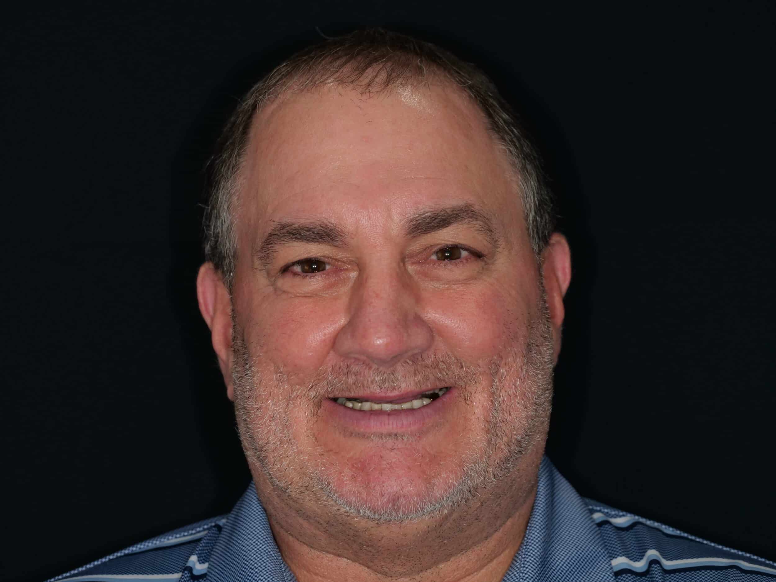 Before Image: Crowns - front