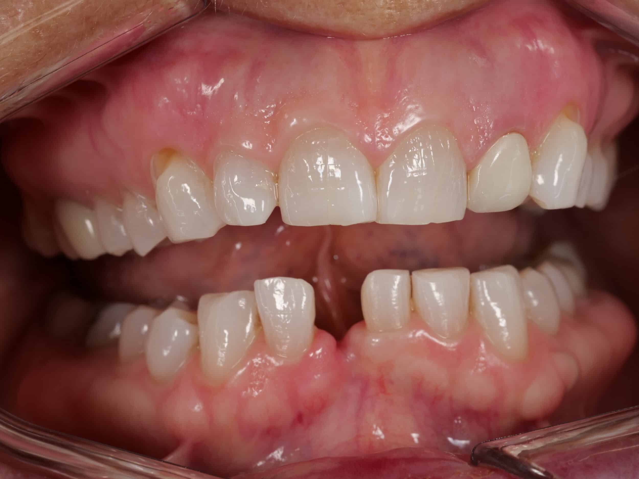 Before Image: Maryland Bridge - front