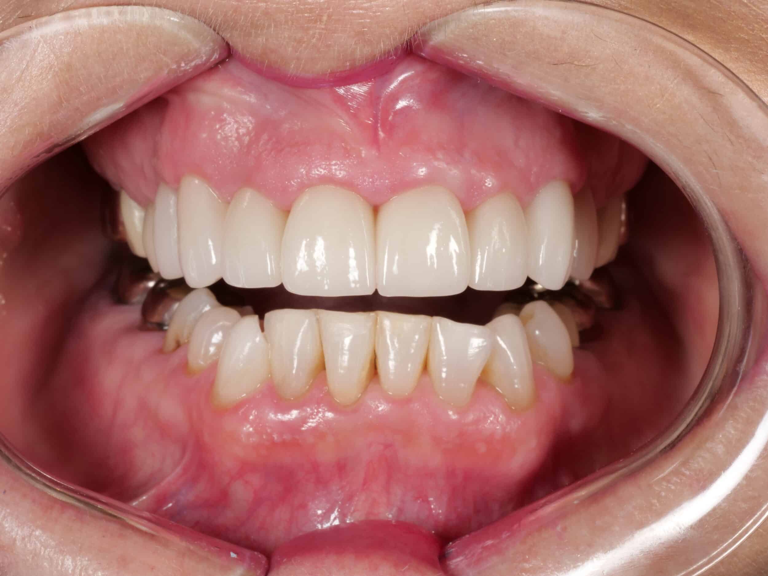 After Image: Smile Makeover - front