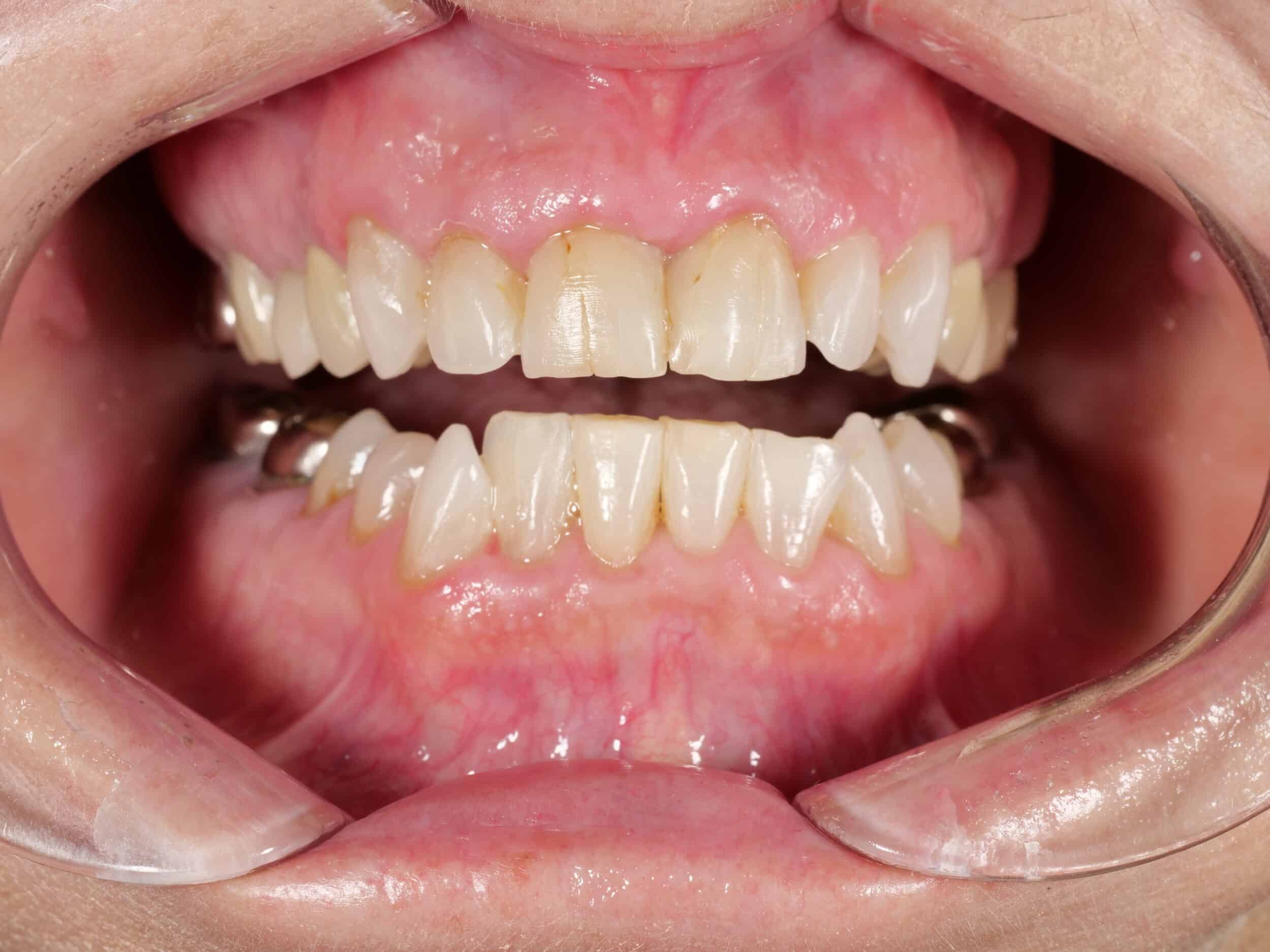 Before Image: Smile Makeover - front